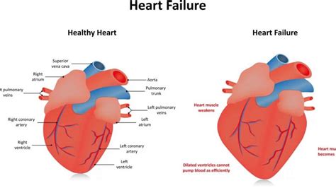 inferolateral hypokinesis definition.